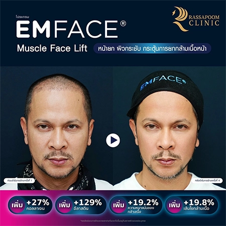 ยกกระชับกล้ามเนื้อ ยกกระชับ EMFACE