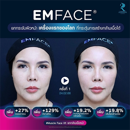 ยกกระชับกล้ามเนื้อ ยกกระชับ EMFACE