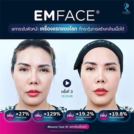 ยกกระชับกล้ามเนื้อ ยกกระชับ EMFACE