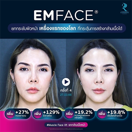 ยกกระชับกล้ามเนื้อ ยกกระชับ EMFACE