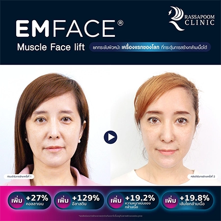 ยกกระชับกล้ามเนื้อ ยกกระชับ EMFACE