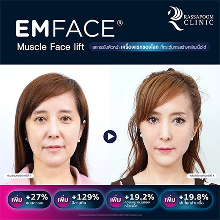 ยกกระชับกล้ามเนื้อ ยกกระชับ EMFACE