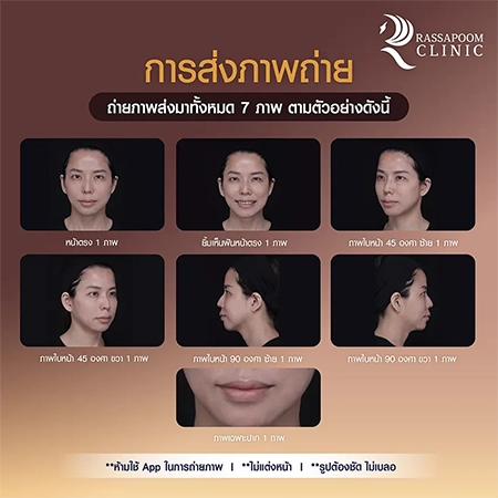 กิจกรรมแจกฟรีโปรแกรมฉีดฟิลเลอร์ 14 cc