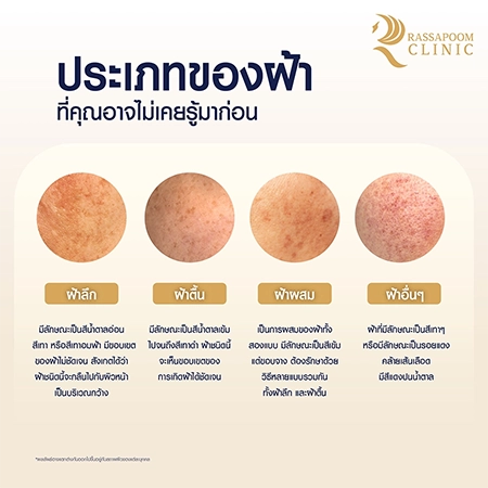 ฝ้า Melasma