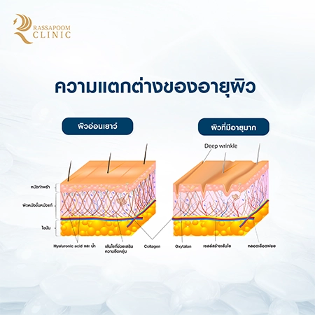 Radiesse Tri-Lift