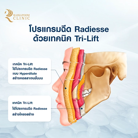 Radiesse Tri-Lift