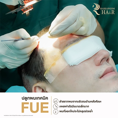 FUE Hair Transplant by Dr. Ken