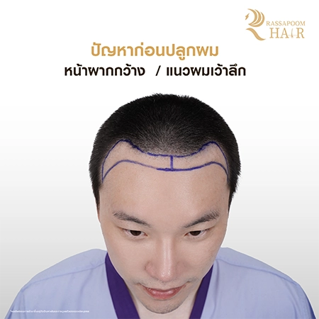 FUE Hair Transplant by Dr. Ken