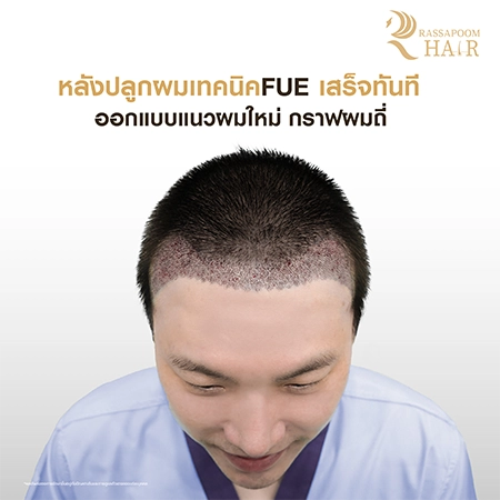 FUE Hair Transplant by Dr. Ken