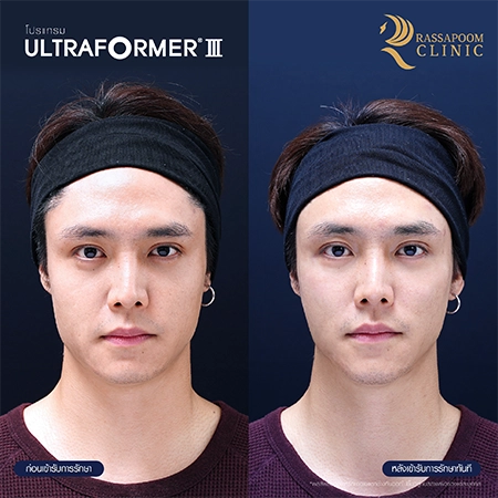 Ultraformer III ยกกระชับ ลดริ้วรอย สลายไขมันใต้ชั้นผิว