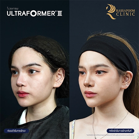 Ultraformer III ยกกระชับ ลดริ้วรอย สลายไขมันใต้ชั้นผิว