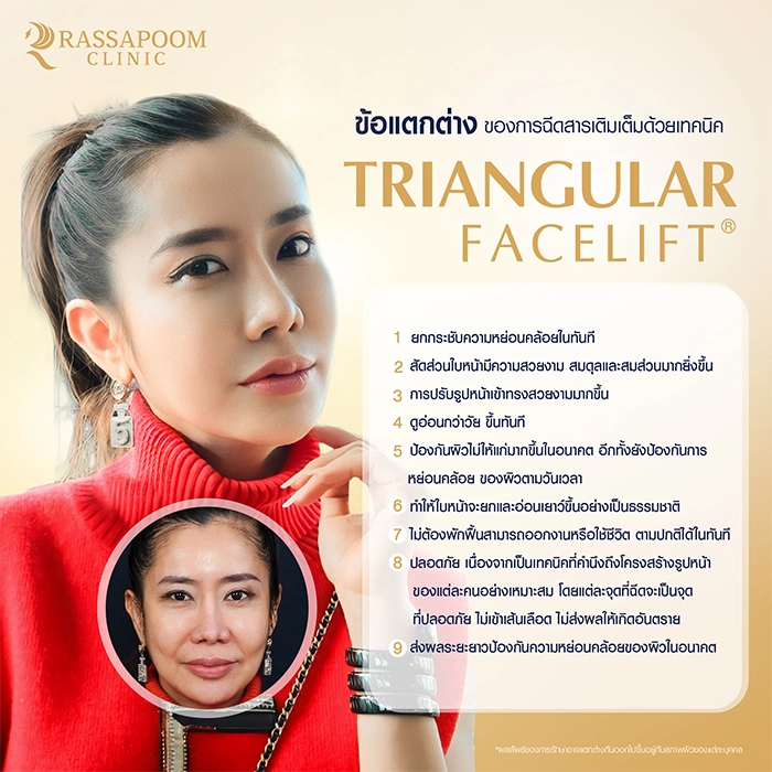 ฉีดฟิลเลอร์ (Triangular Face Lift)