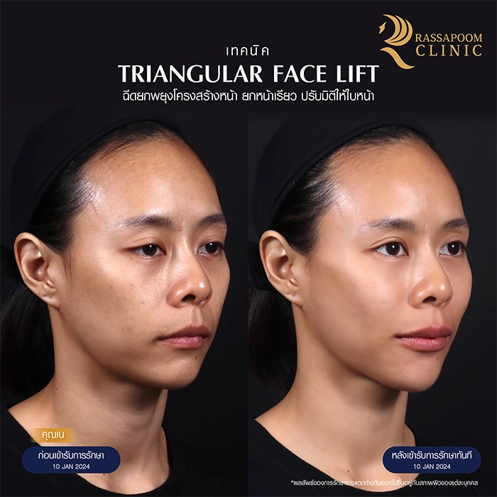 ฉีดยกพยุงโครงสร้างใบหน้า Triangular Face Lift คุณเนติกาญจน์ มหิทธิพงศ์กุล