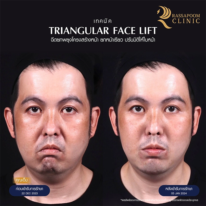 ฉีดยกพยุงโครงสร้างใบหน้า Triangular Face Lift คุณเอ็ม อนรรฆนนท์ นวกิจไพฑูรย์