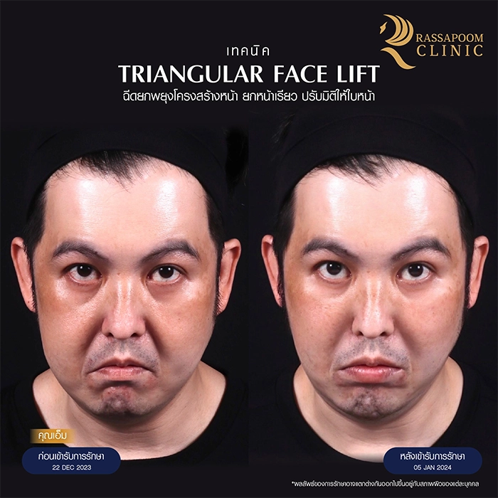 ฉีดยกพยุงโครงสร้างใบหน้า Triangular Face Lift คุณเอ็ม อนรรฆนนท์ นวกิจไพฑูรย์