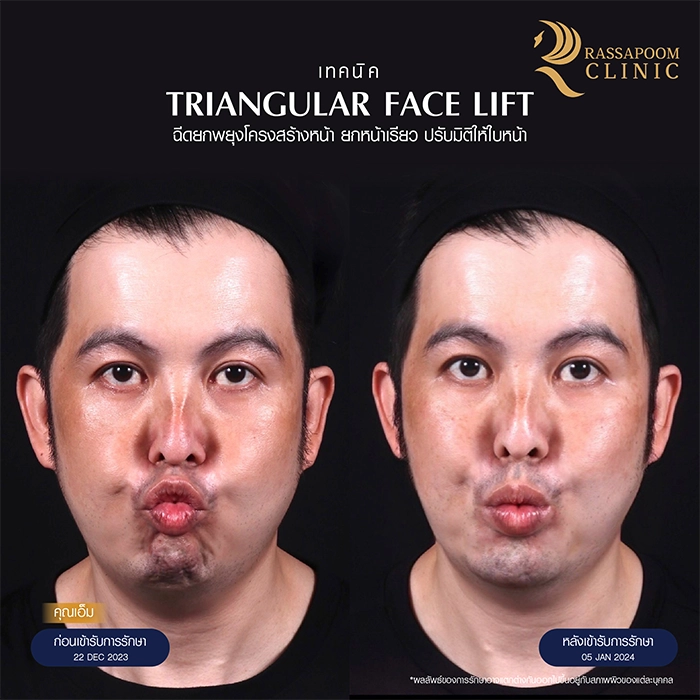 ฉีดยกพยุงโครงสร้างใบหน้า Triangular Face Lift คุณเอ็ม อนรรฆนนท์ นวกิจไพฑูรย์