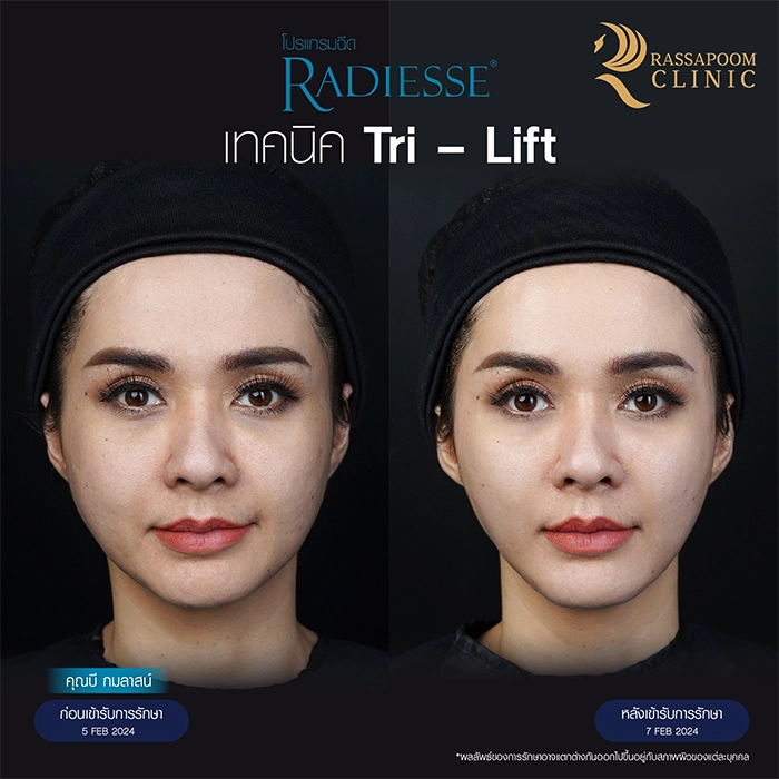 Radiesse Filler คุณบี กมลาสน์ เอียดศรีชาย