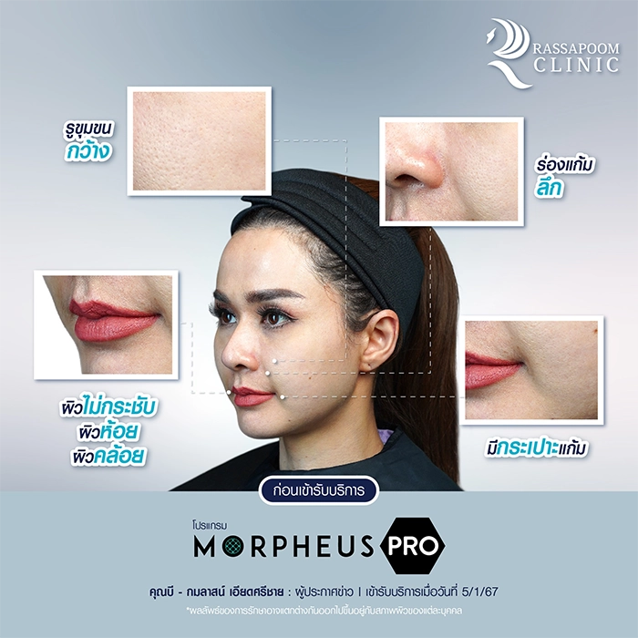 Morpheus Pro คุณบี กมลาสน์ เอียดศรีชาย