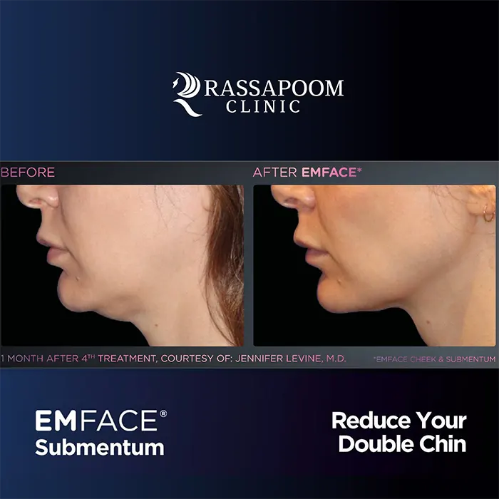 EMFACE Submentum ลดเหนียง