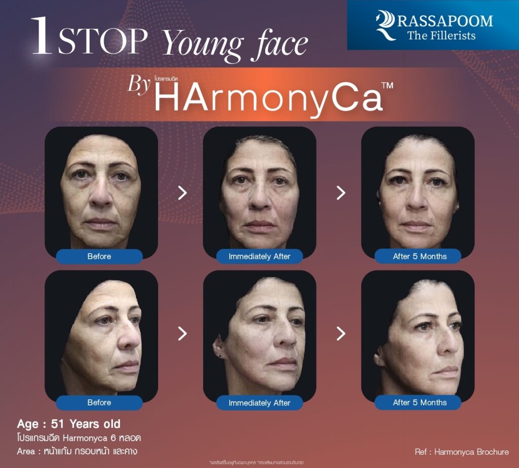 HArmonyCa Before and After