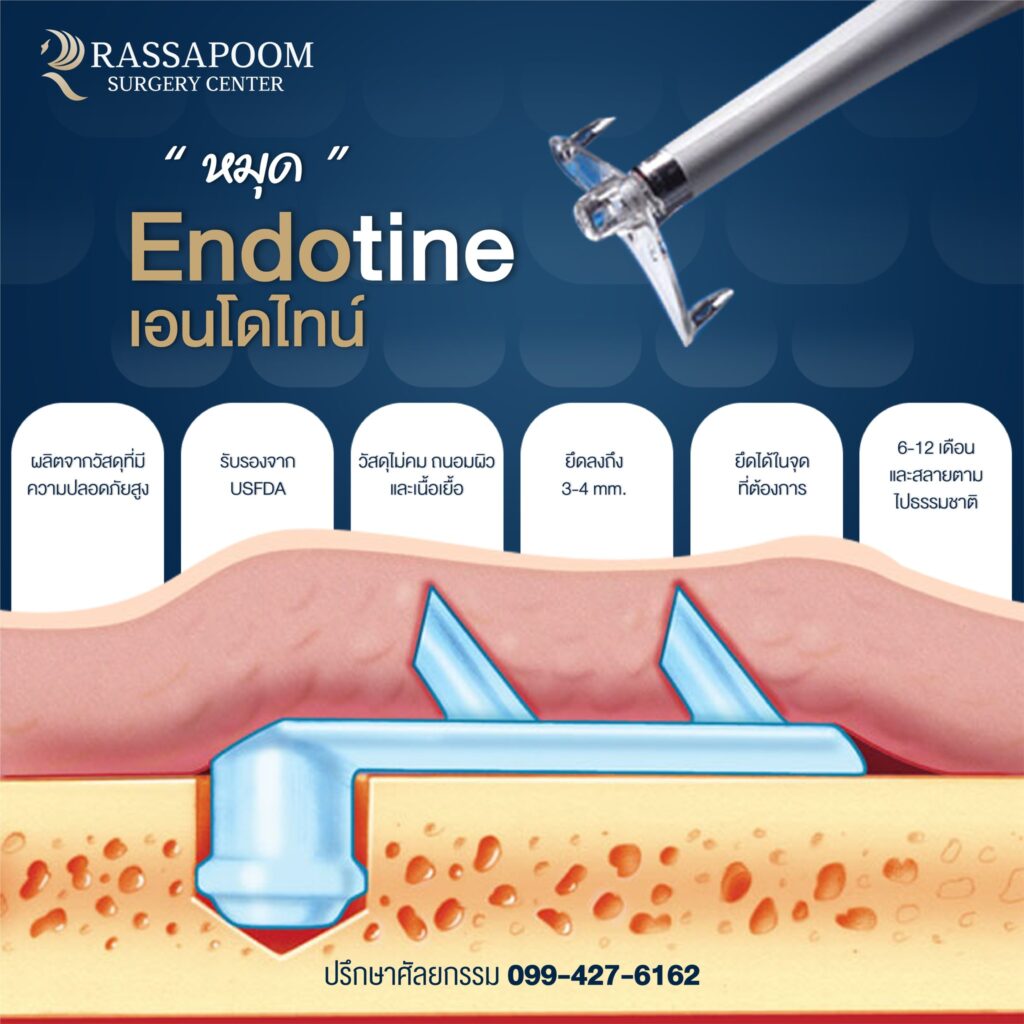 หมุด Endotine ทำหน้าที่อย่างไร ?
โปรแกรมดึงหน้า Endotine แก้ปัญหาผิวหน้าหย่อนคล้อย ด้วยหมุด Endotine 