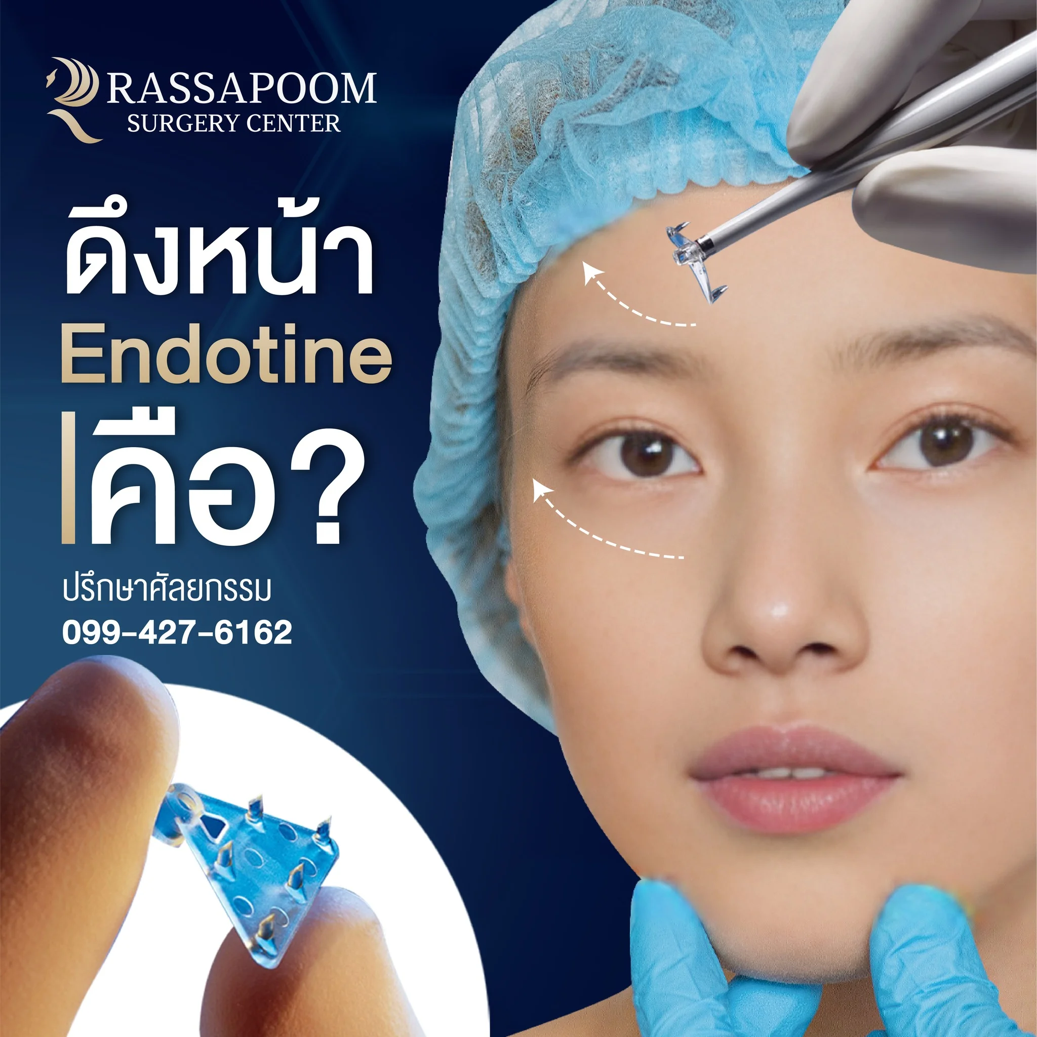 โปรแกรมการดึงหน้า Endotine คือเทคโนโลยีการยกกระชับผิว แก้ปัญหาผิวหน้าหย่อนคล้อย ด้วยวัสดุทางการแพทย์ที่เรียกว่า “หมุด Endotine”