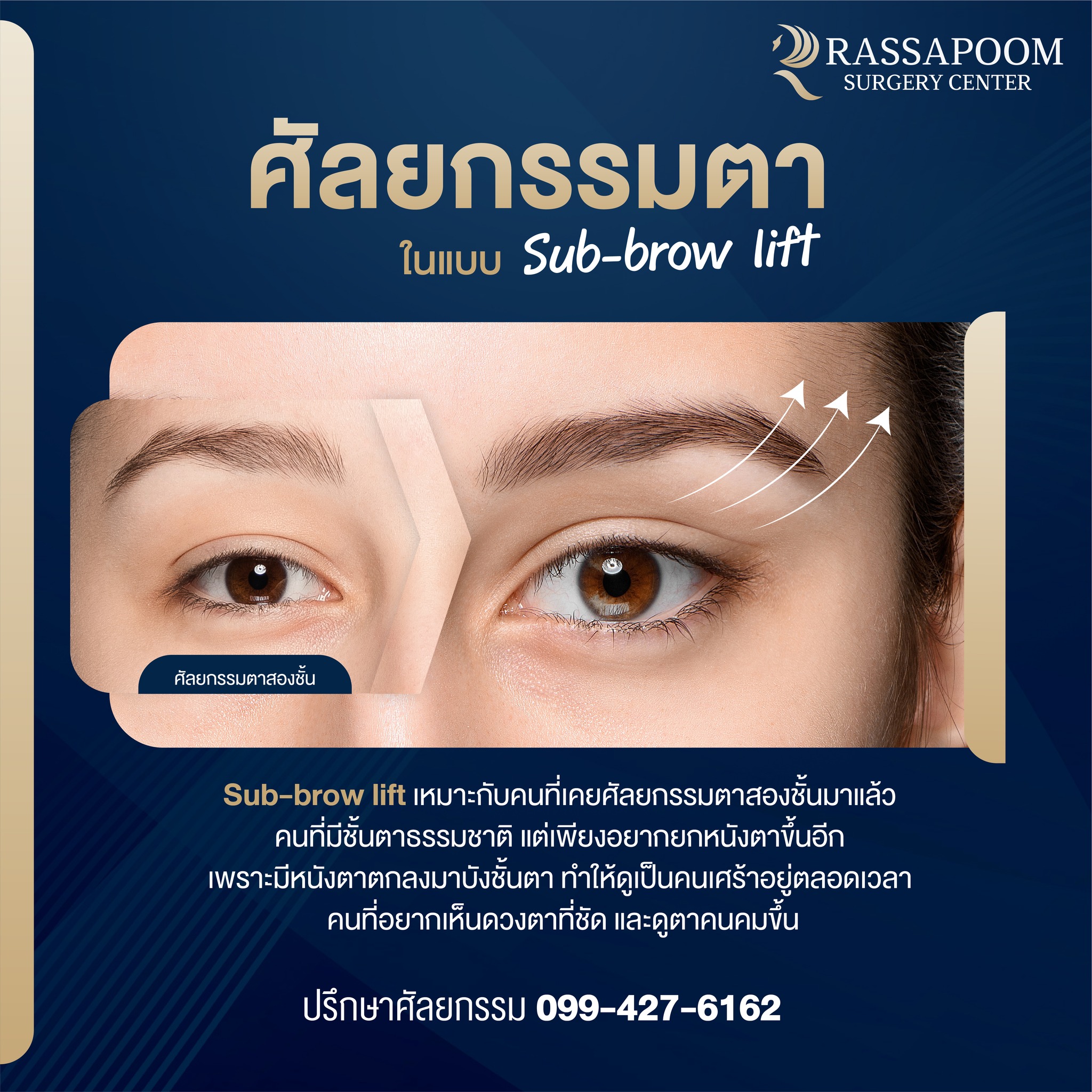 โปรแกรมยกหางตา (Subbrow Lifting)