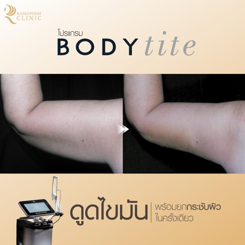 ผลลัพธ์ดูดไขมันต้นแขนด้วยโปรแกรม Bodytite pro