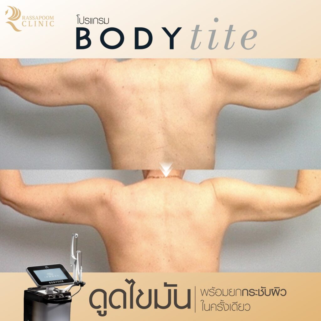 รีวิวดูดไขมันต้นแขน bodytite