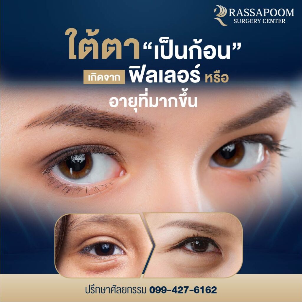โปรแกรมตัดถุงใต้ตา (Lower Blepharoplasty)