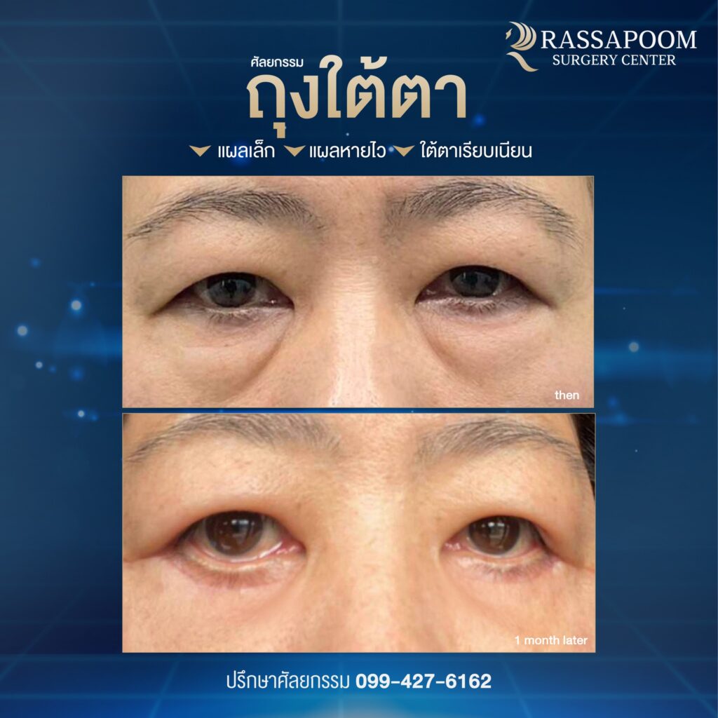 โปรแกรมยกหางตา (Subbrow Lifting)