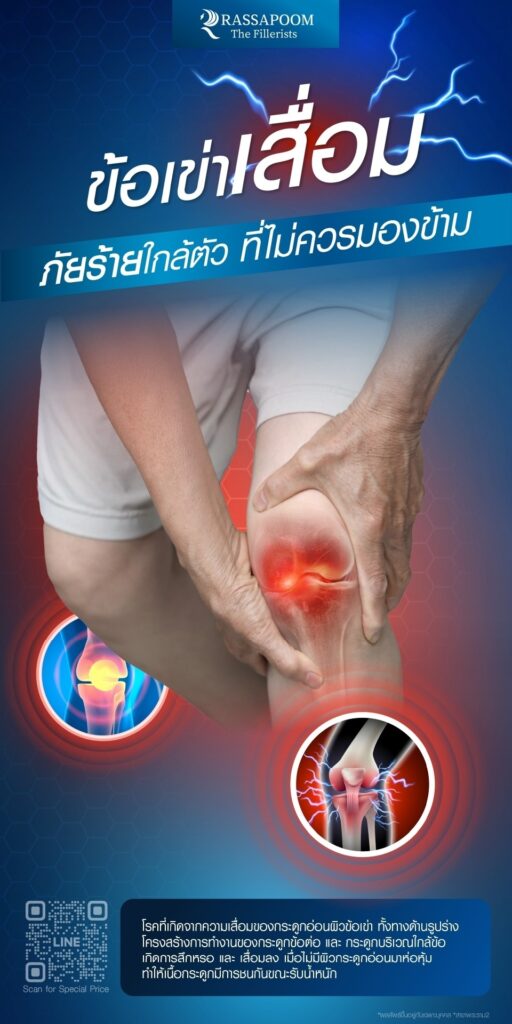 Knee Osteoarthritis