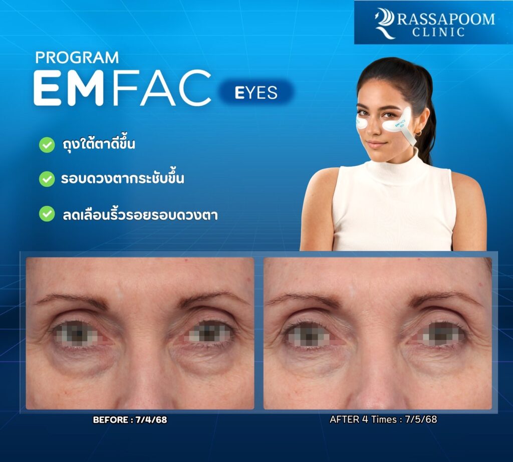 รีวิวโปรแกรม Em face eye