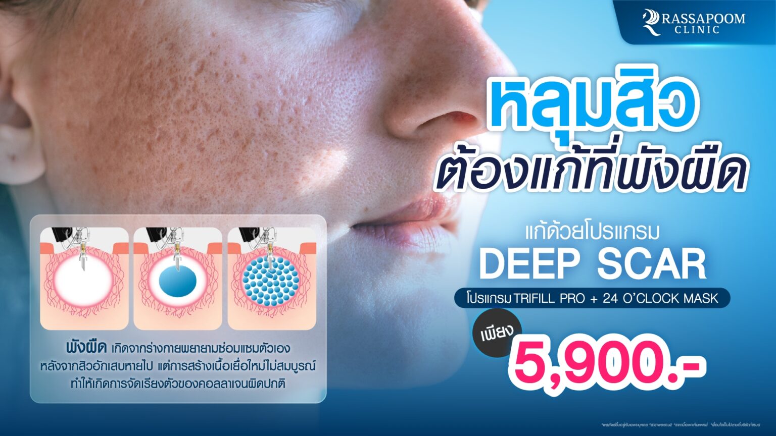 โปรแกรม Deep Scar - Rassapoom Clinic