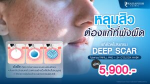 โปนแกรมหลุมสิว