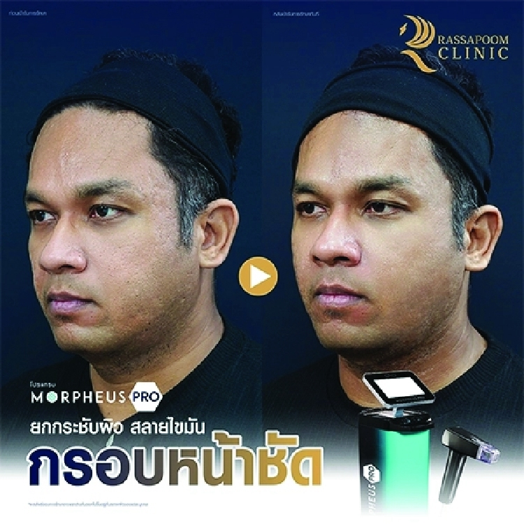 โปรแกรม Morpheus Pro ยกกระชับผิวหน้า คืนความอ่อนเยาว์