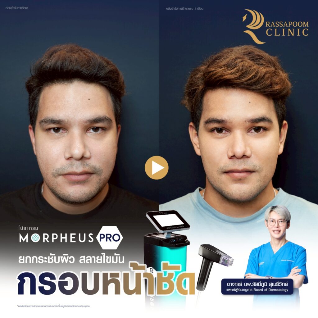 โปรแกรม Morpheus Pro ยกกระชับผิวหน้า คืนความอ่อนเยาว์