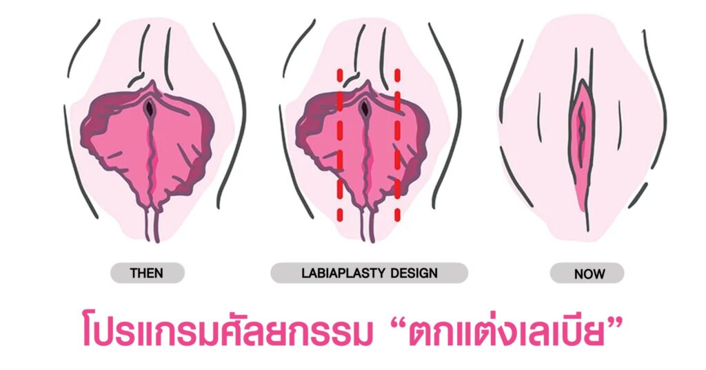 ศัลยกรรมตกแต่งเลเบีย