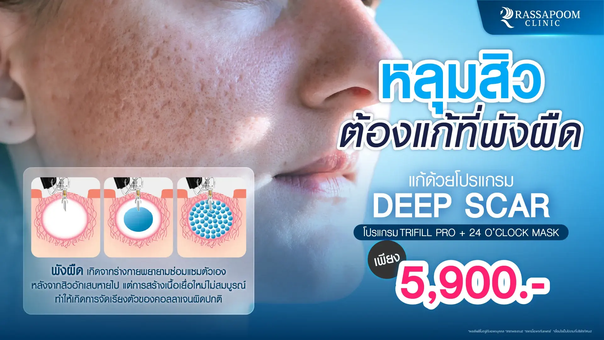 รักษาหลุมสิว Deep Scar