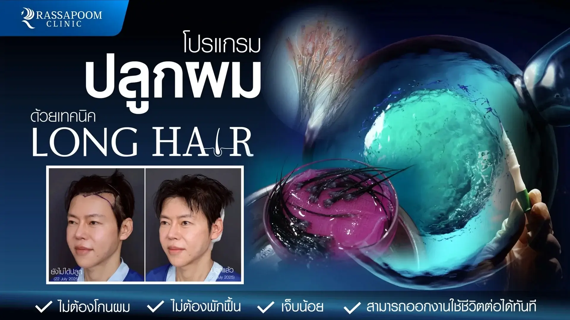 เทคนิค Long Hair (Non - Shaven FUE)