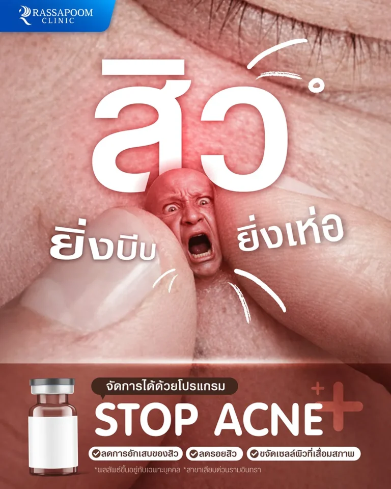 ลดอาการอักเสบ สิว