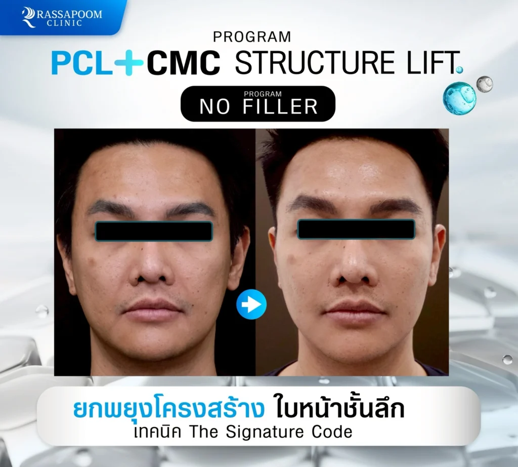 ผลลัพธ์หลังการทำ pcl+cmc
