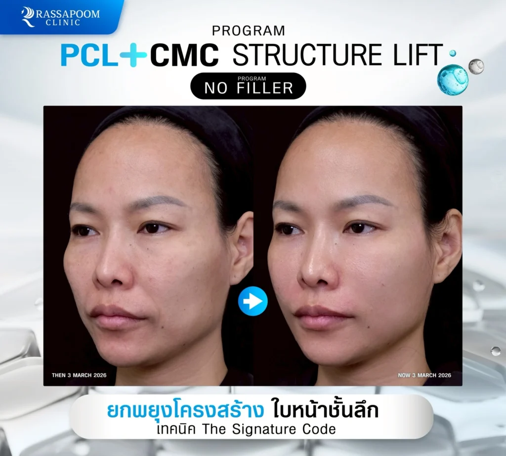 ผลลัพธ์หลังการทำ pcl+cmc