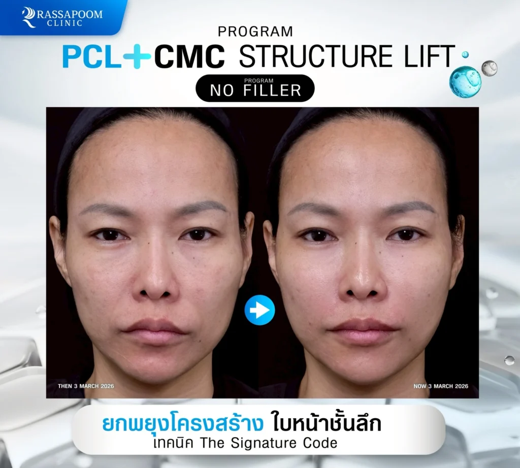 ผลลัพธ์หลังการทำ pcl+cmc