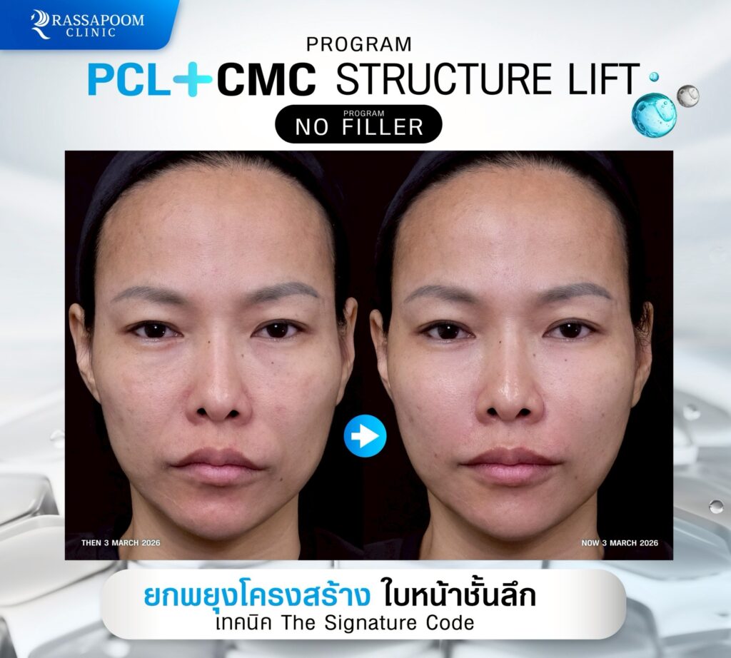 ผลลัพธ์หลังทำโปรแกรม ellanse
