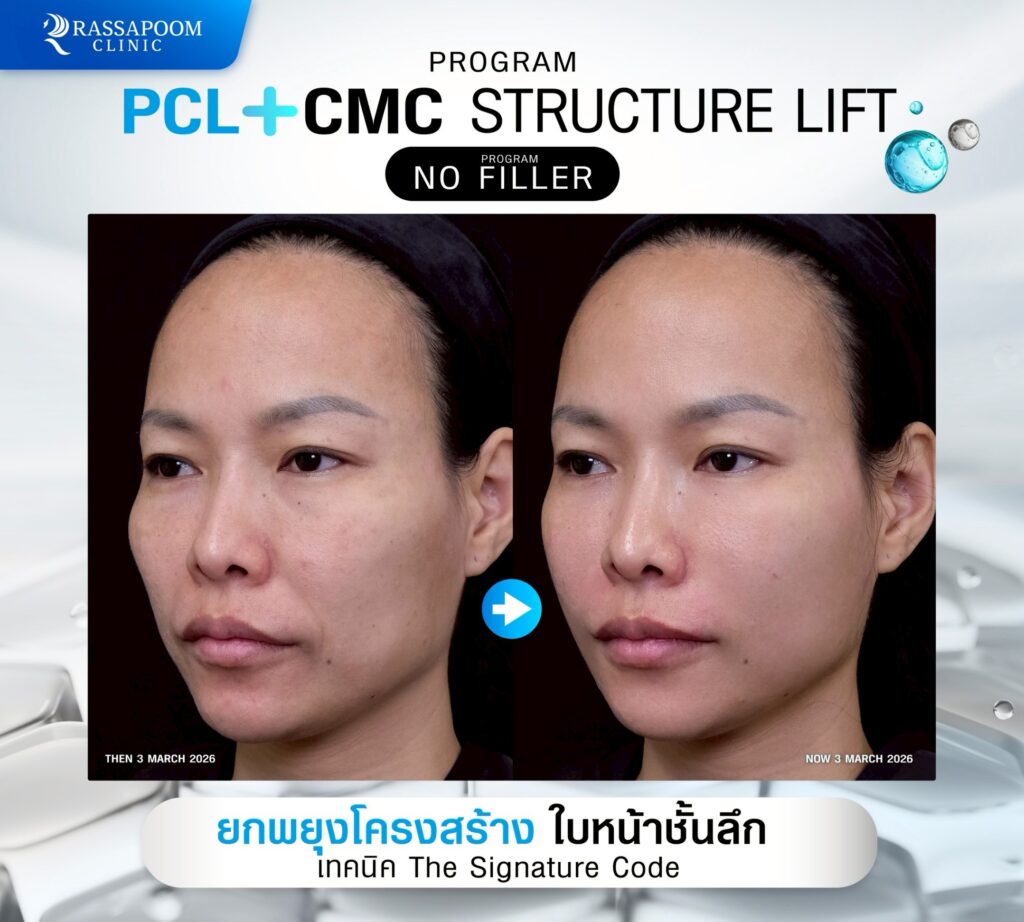 ผลลัพธ์หลังทำโปรแกรม ellanse