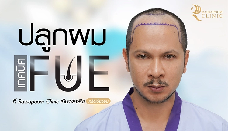 ปลูกผมเทคนิค FUE เห็นผลจริง (คุณแช่ม แช่มรัมย์)
