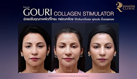 ฉีดโปรแกรม Gouri แก้ปัญหาผิวหน้า (คุณนานา โฮไซนา)