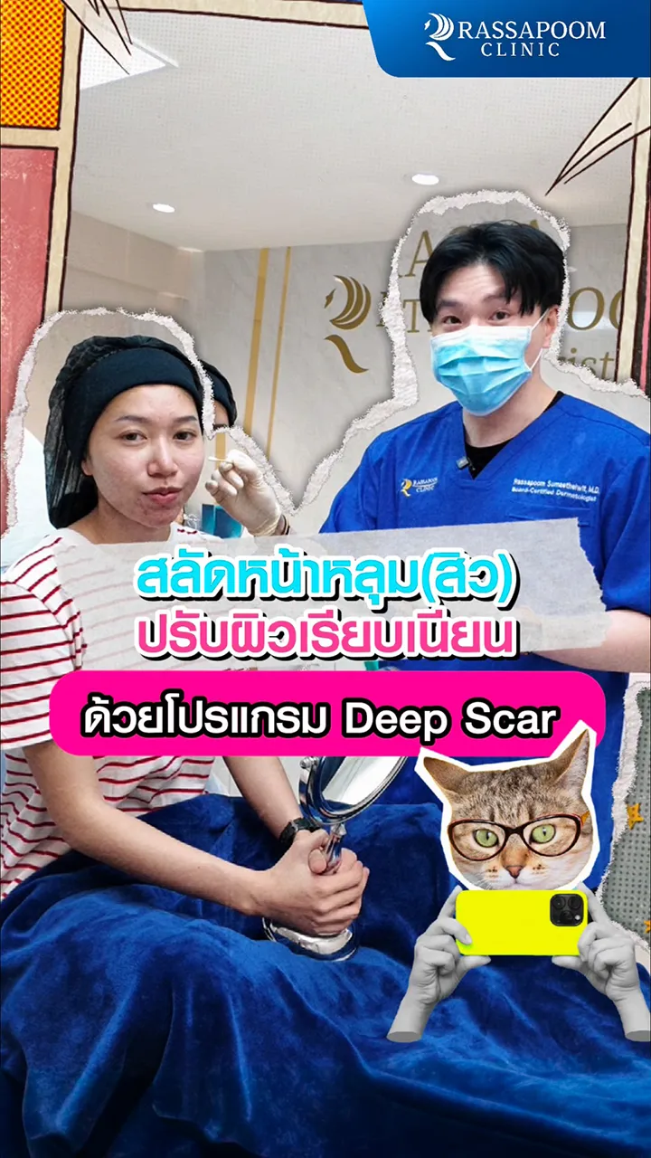 โปรแกรม DEEP SCAR เกลี่ยผิว กลบหลุมสิว ให้เรียบเนียน
