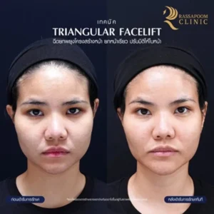 ผลลัพธ์หลังทำ โปรแกรม Triangular facelift